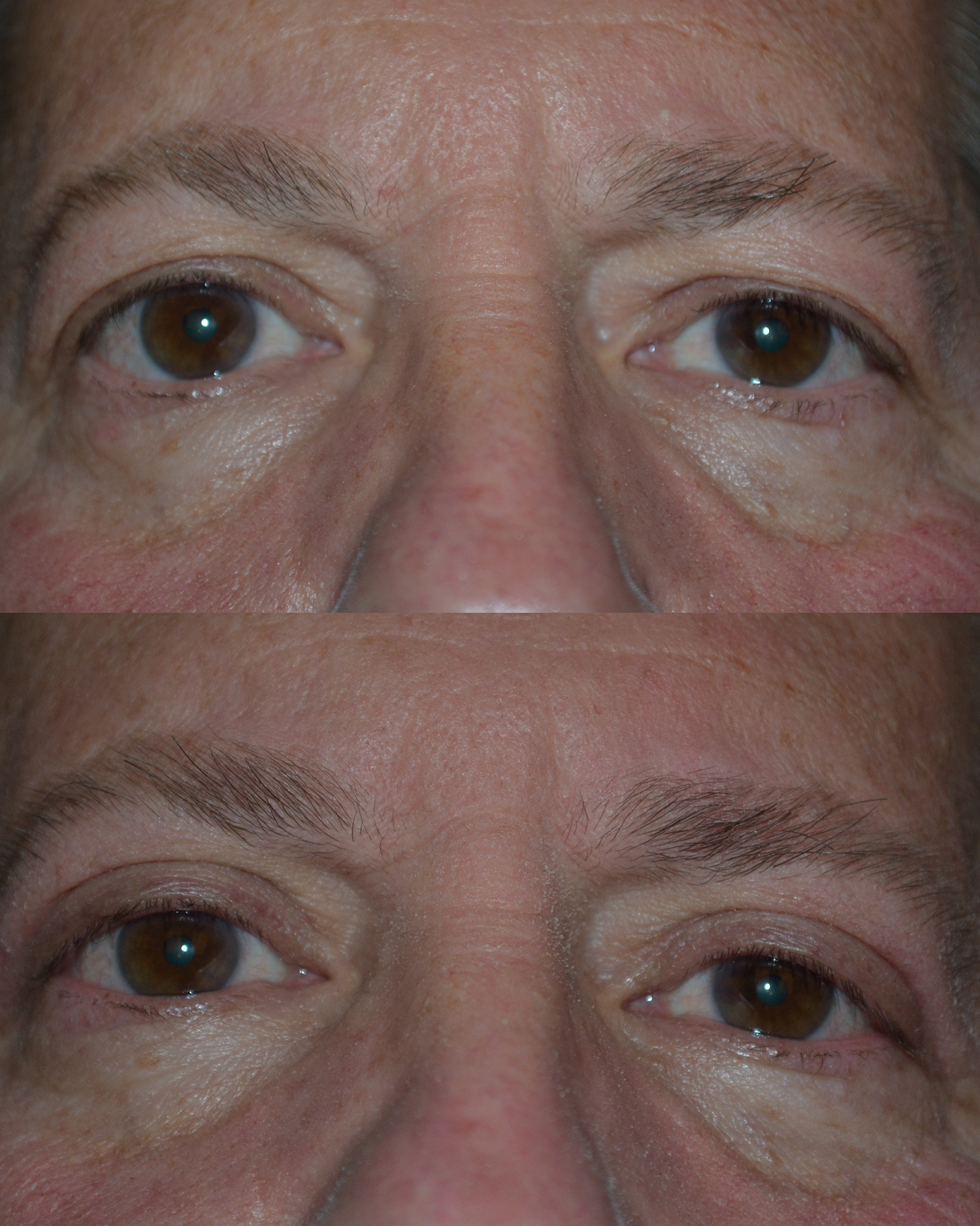 Eyelid Surgery Before and After Photo by Renaissance Plastic Surgery in Troy Michigan