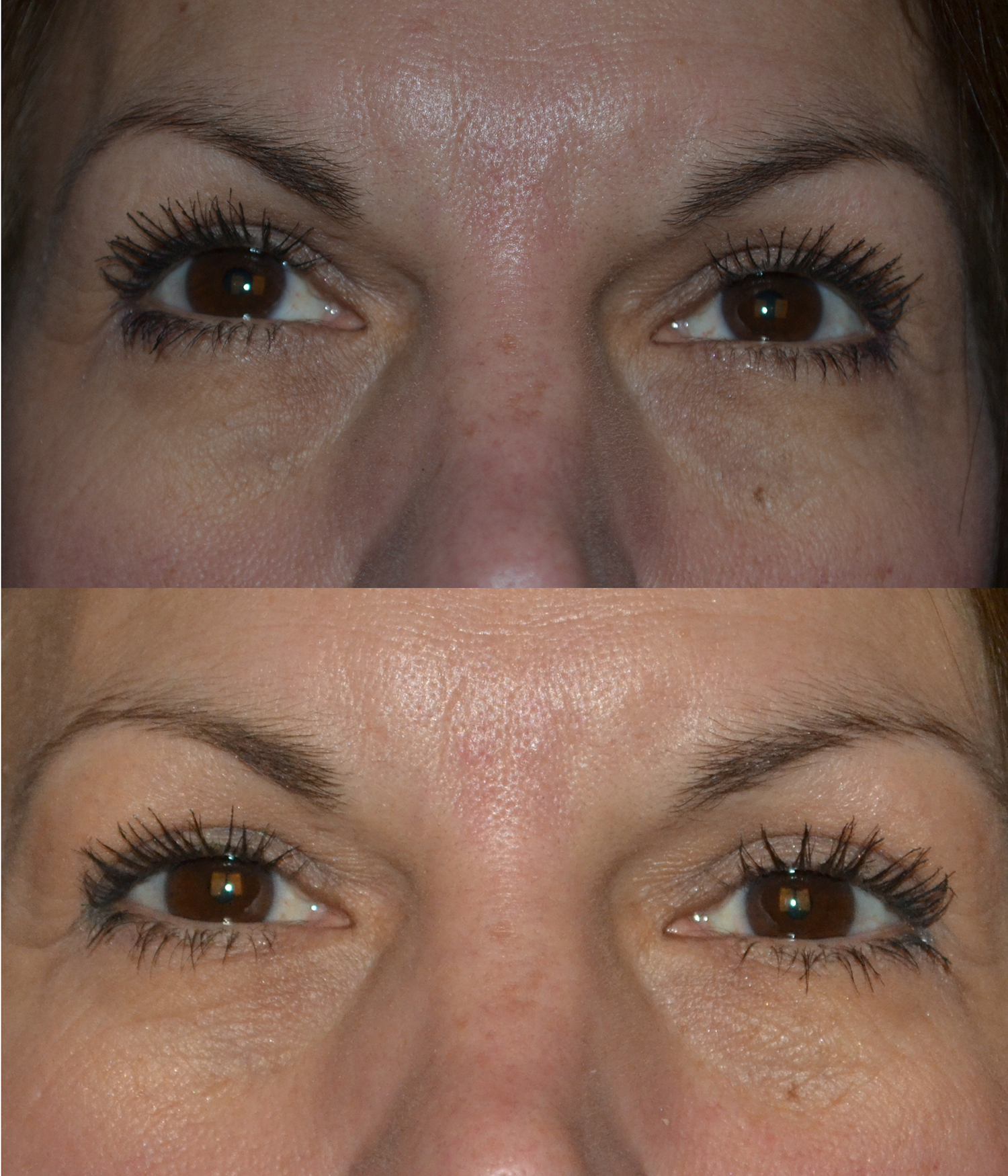 Eyelid Surgery Before and After Photo by Renaissance Plastic Surgery in Troy Michigan