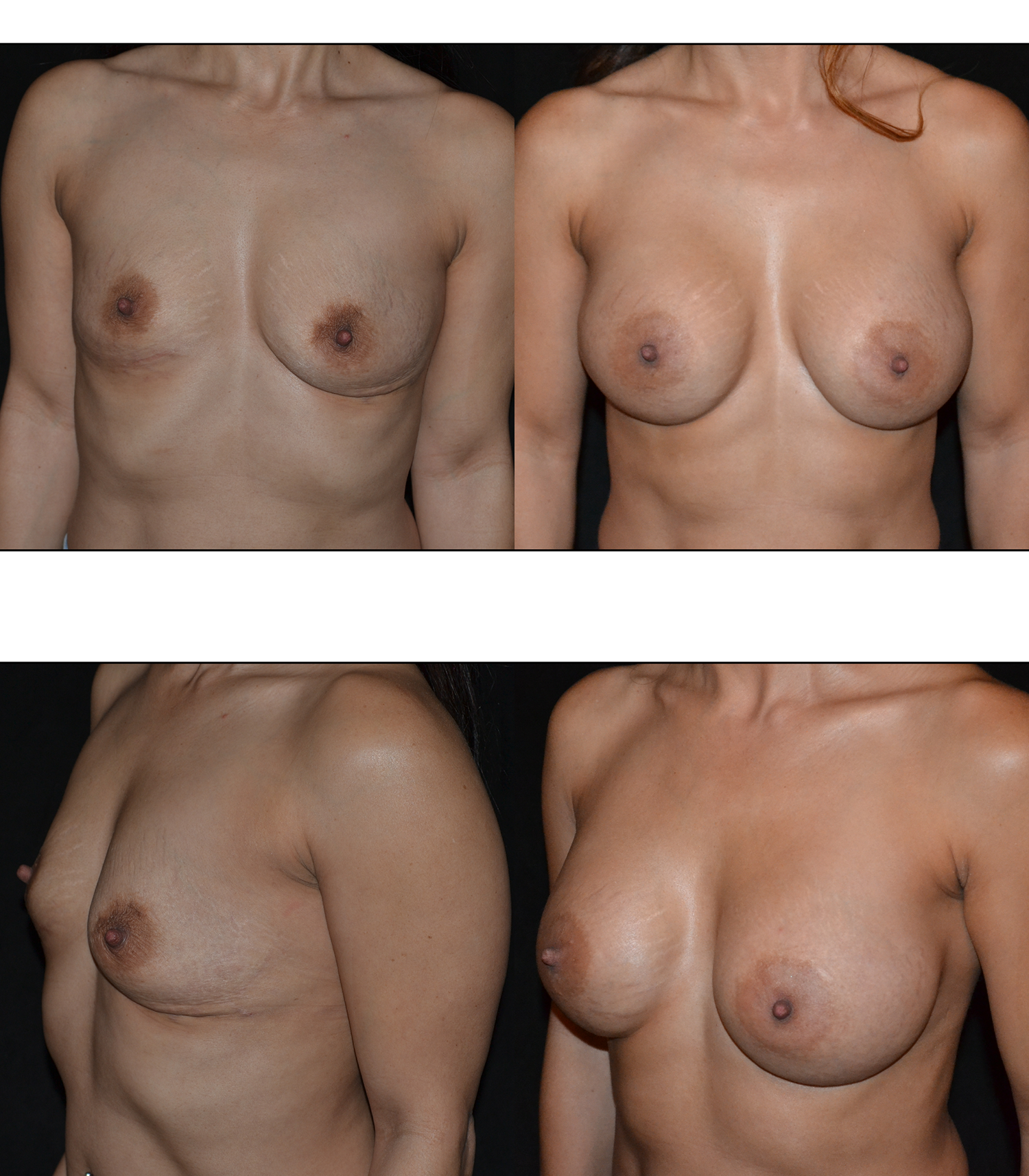 Breast Augmentation Before and After Photo by Renaissance Plastic Surgery in Troy Michigan
