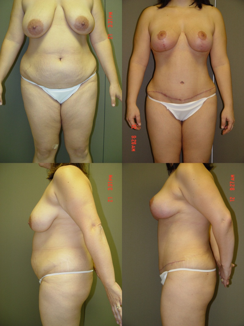 Breast Lift Before and After Photo by Renaissance Plastic Surgery in Troy Michigan