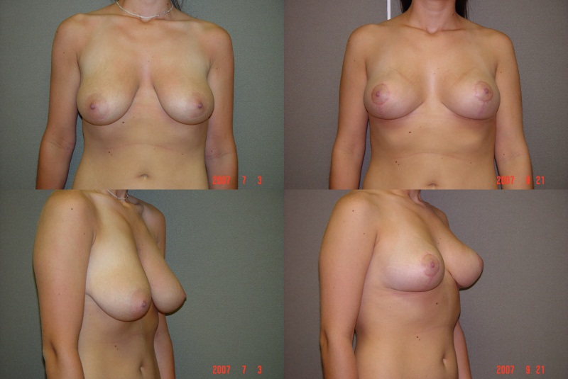 Breast Lift Before and After Photo by Renaissance Plastic Surgery in Troy Michigan