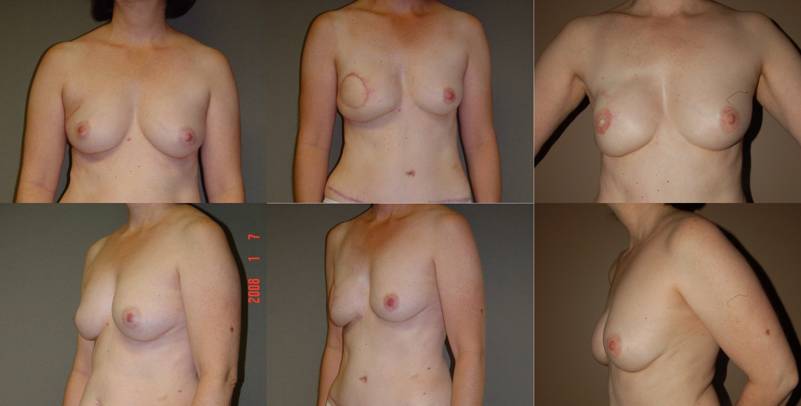 Breast Reconstruction (Transverse Rectus Abdominus Muscle – TRAM) Before and After Photo by Renaissance Plastic Surgery in Troy Michigan