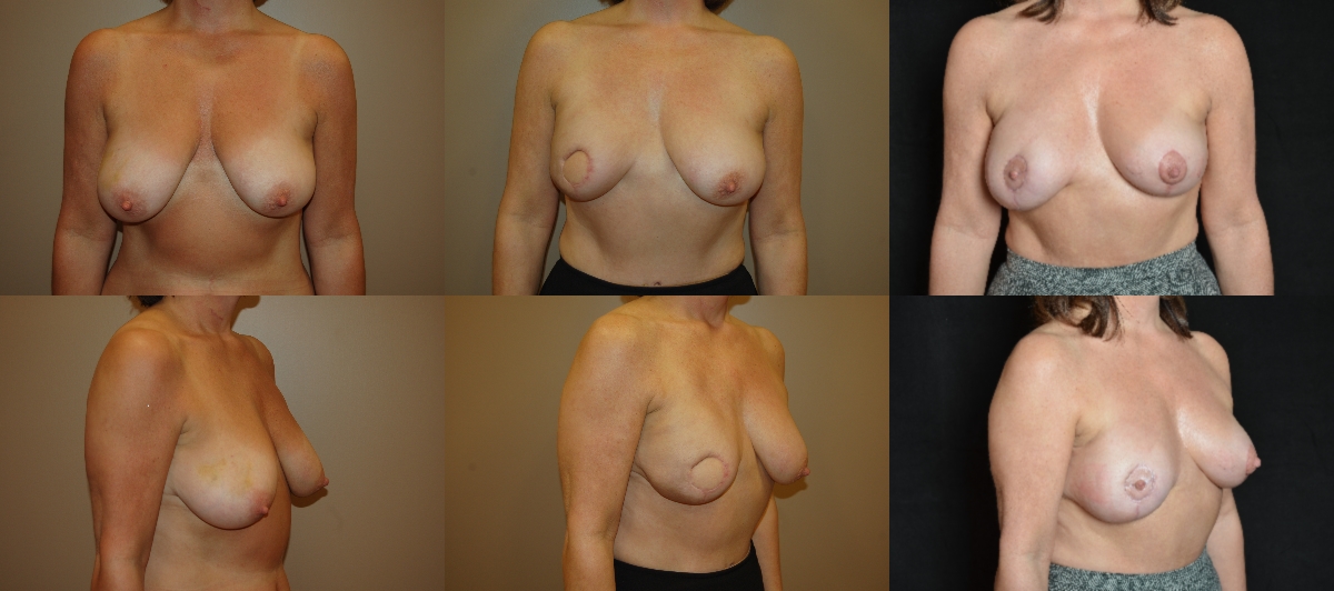 Breast Reconstruction (Transverse Rectus Abdominus Muscle – TRAM) Before and After Photo by Renaissance Plastic Surgery in Troy Michigan