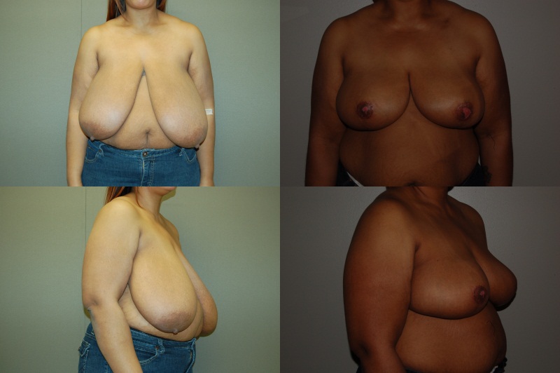 Breast Reduction Before and After Photo by Renaissance Plastic Surgery in Troy Michigan