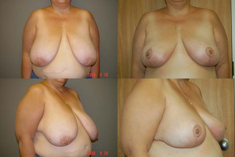 Breast Reduction Before and After Photo by Renaissance Plastic Surgery in Troy Michigan