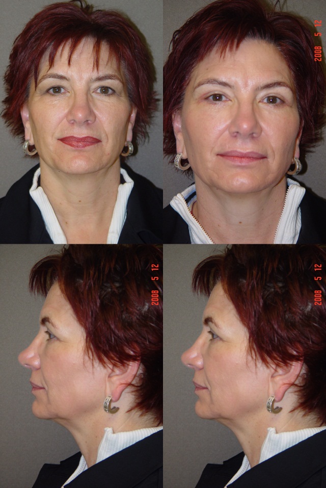 Deep Dermabrasion (Laser Resurfacing) Before and After Photo by Renaissance Plastic Surgery in Troy Michigan
