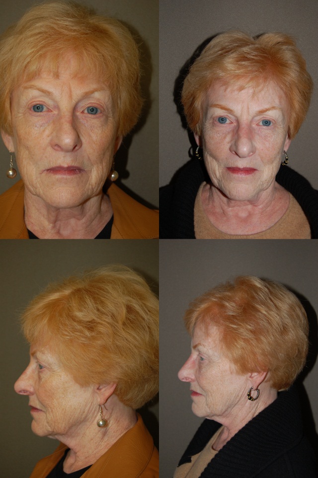 Deep Dermabrasion (Laser Resurfacing) Before and After Photo by Renaissance Plastic Surgery in Troy Michigan