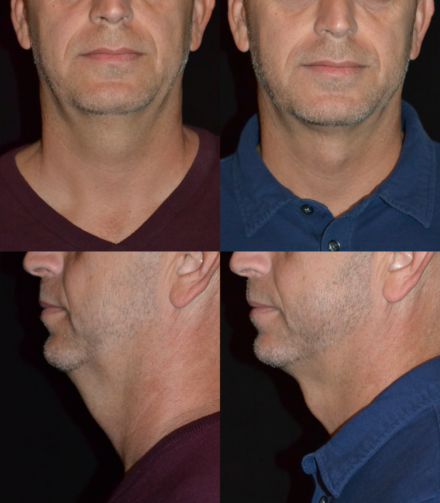 Facial Liposuction Before and After Photo by Renaissance Plastic Surgery in Troy Michigan