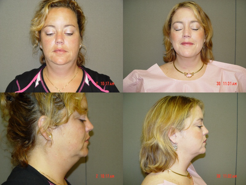 Facial Liposuction Before and After Photo by Renaissance Plastic Surgery in Troy Michigan