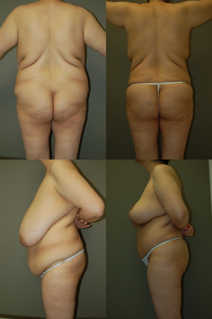 Autologous Fat Transfer Before and After Photo by Renaissance Plastic Surgery in Troy Michigan