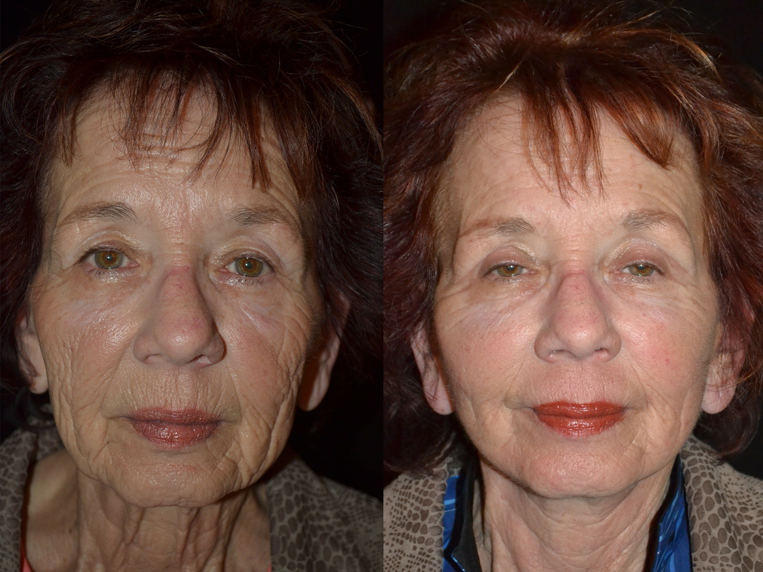 Facial Autologous Fat Transfer Before and After Photo by Renaissance Plastic Surgery in Troy Michigan