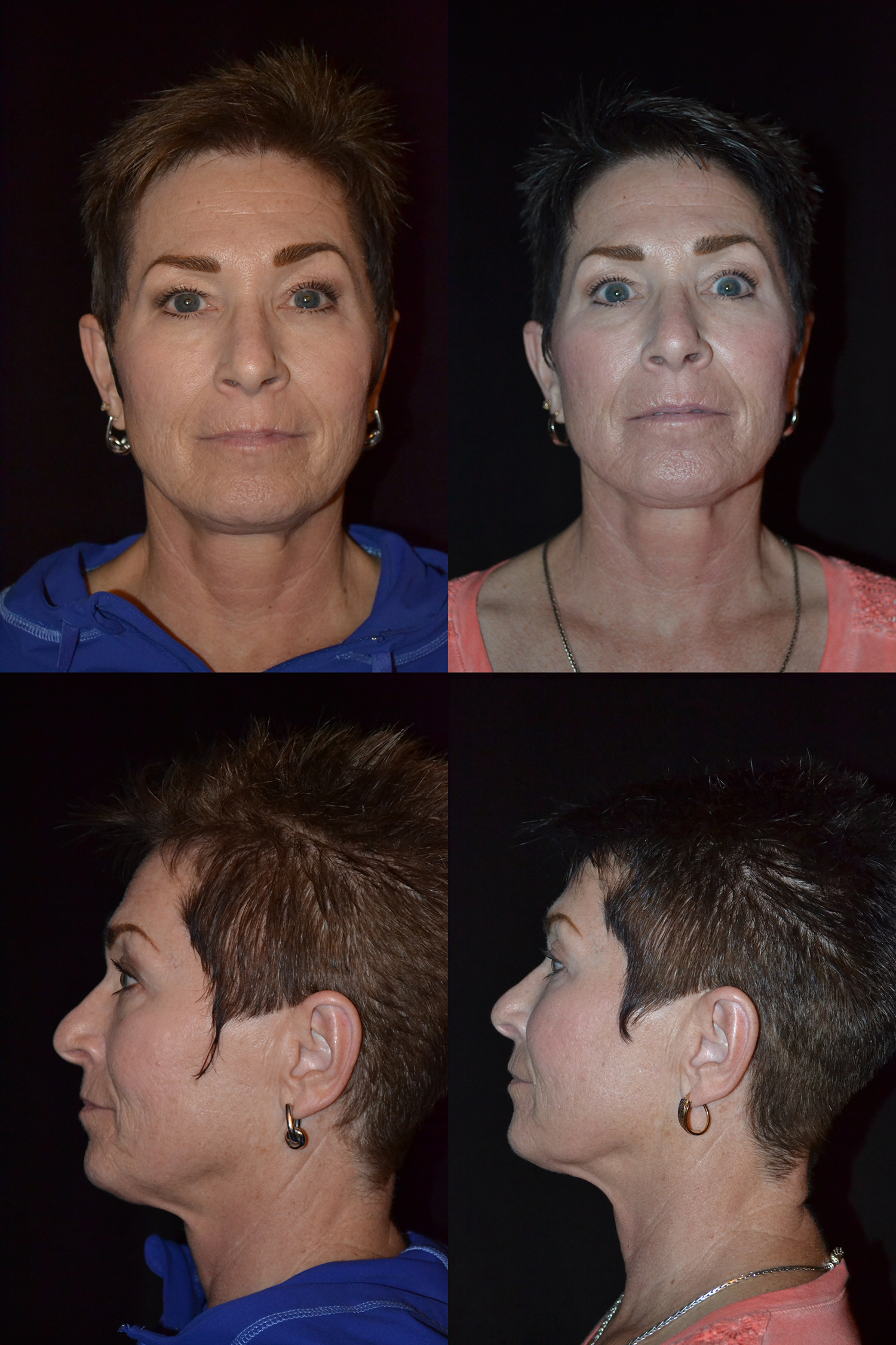 Facial Autologous Fat Transfer Before and After Photo by Renaissance Plastic Surgery in Troy Michigan