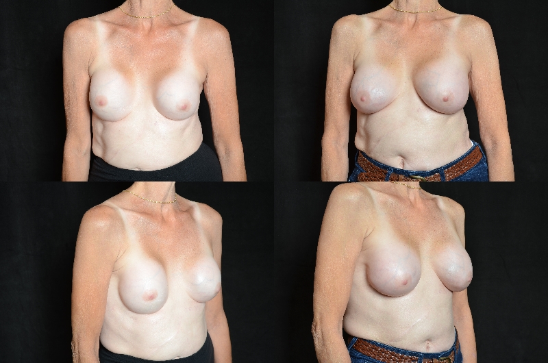 Capsulectomy (Implant Exchange) Before and After Photo by Renaissance Plastic Surgery in Troy Michigan