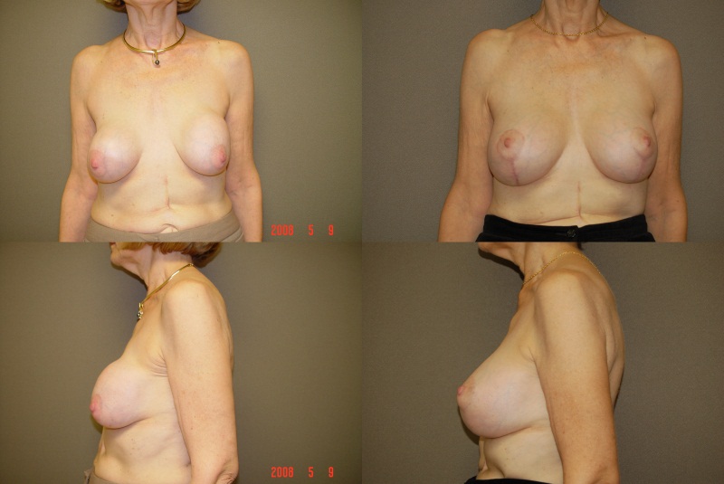 Capsulectomy (Implant Exchange) Before and After Photo by Renaissance Plastic Surgery in Troy Michigan