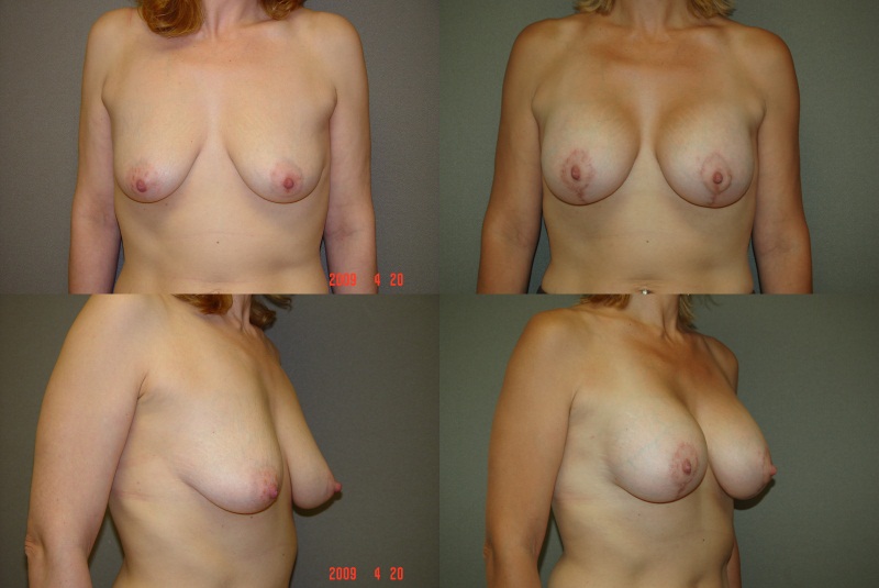 Masto-Aug (Breast Lift with Implants) Before and After Photo by Renaissance Plastic Surgery in Troy Michigan