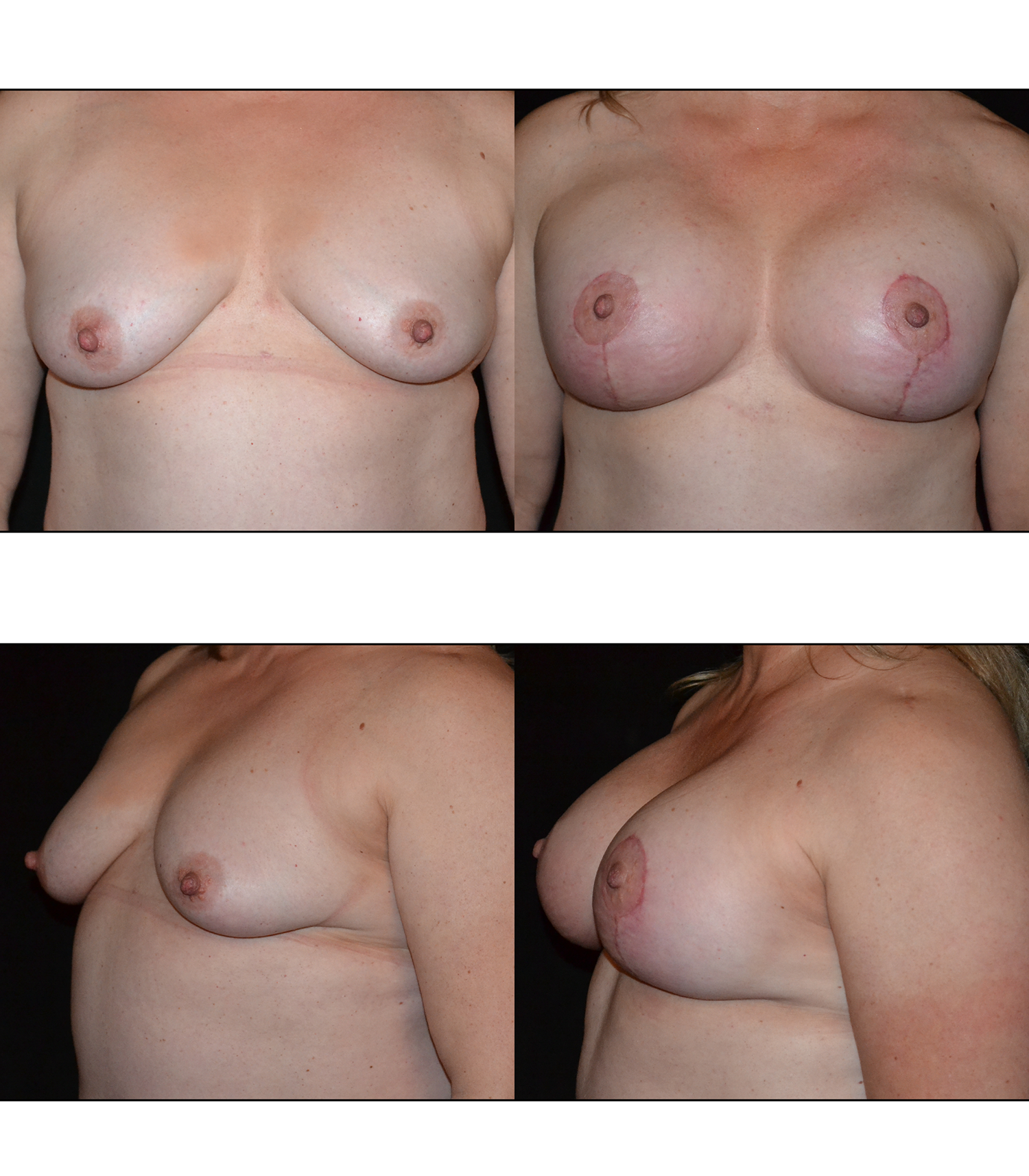 Masto-Aug (Breast Lift with Implants) Before and After Photo by Renaissance Plastic Surgery in Troy Michigan