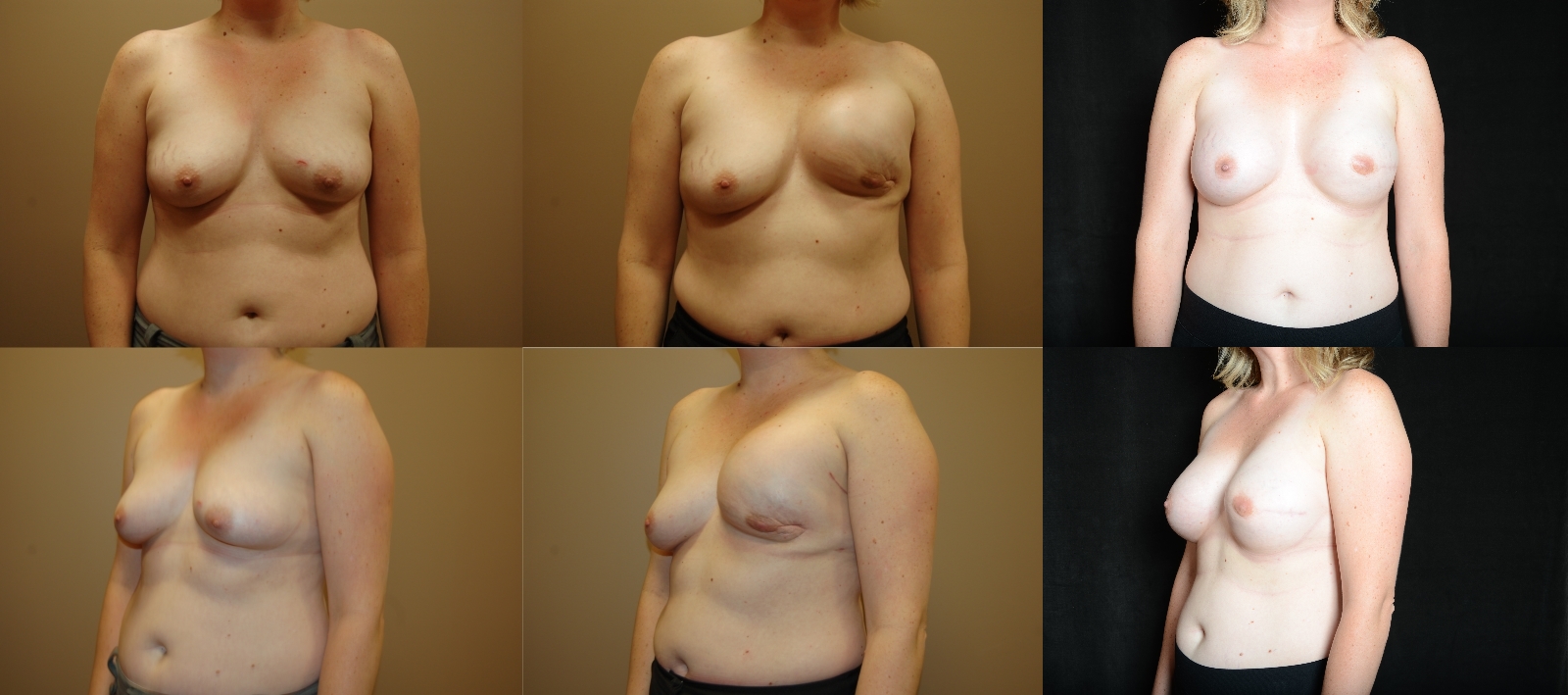Breast Reconstruction (Nipple/Areola/Skin Sparring) Before and After Photo by Renaissance Plastic Surgery in Troy Michigan