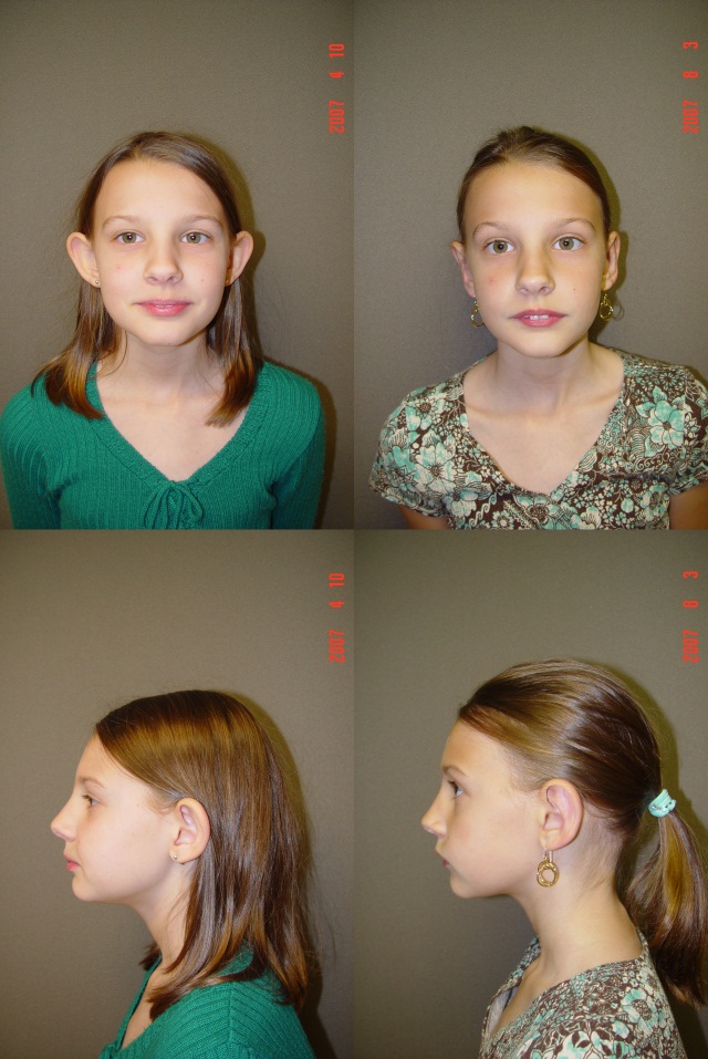 Otoplasty Before and After Photo by Renaissance Plastic Surgery in Troy Michigan
