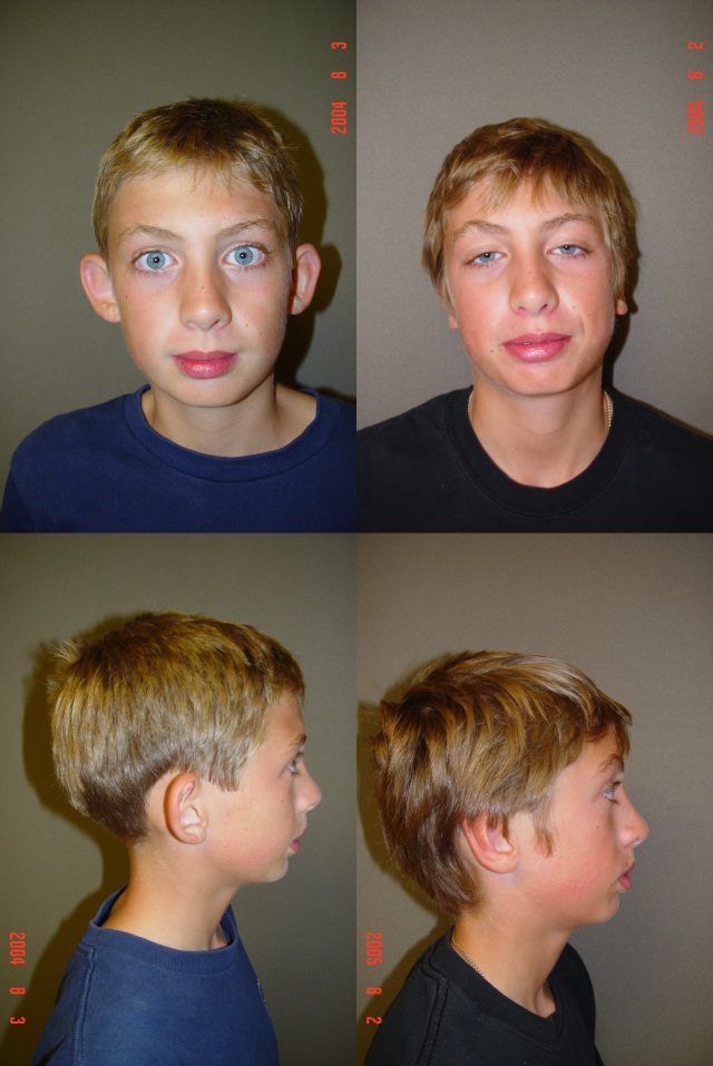 Otoplasty Before and After Photo by Renaissance Plastic Surgery in Troy Michigan