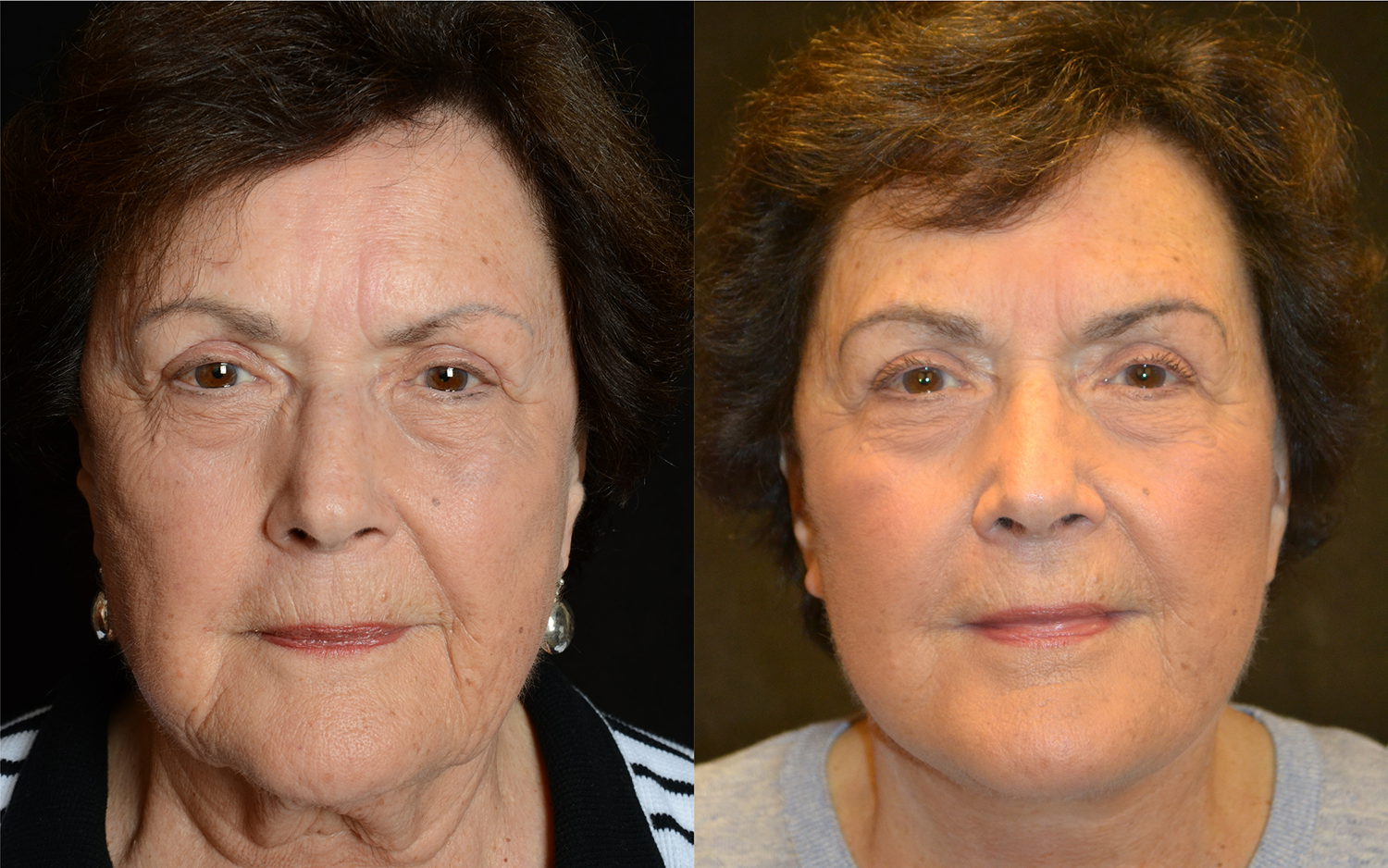Facelift Before and After Photo by Renaissance Plastic Surgery in Troy Michigan