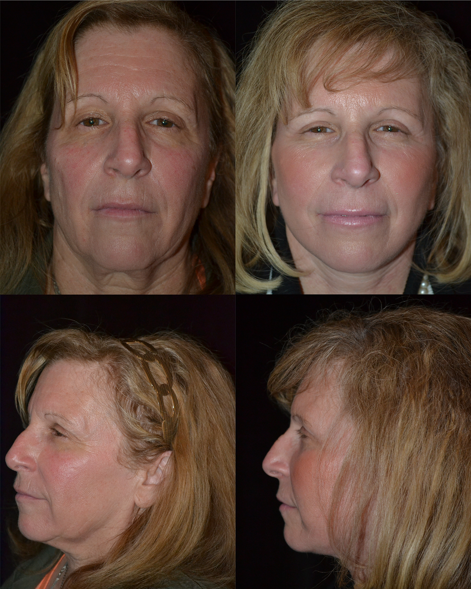 Facelift Before and After Photo by Renaissance Plastic Surgery in Troy Michigan