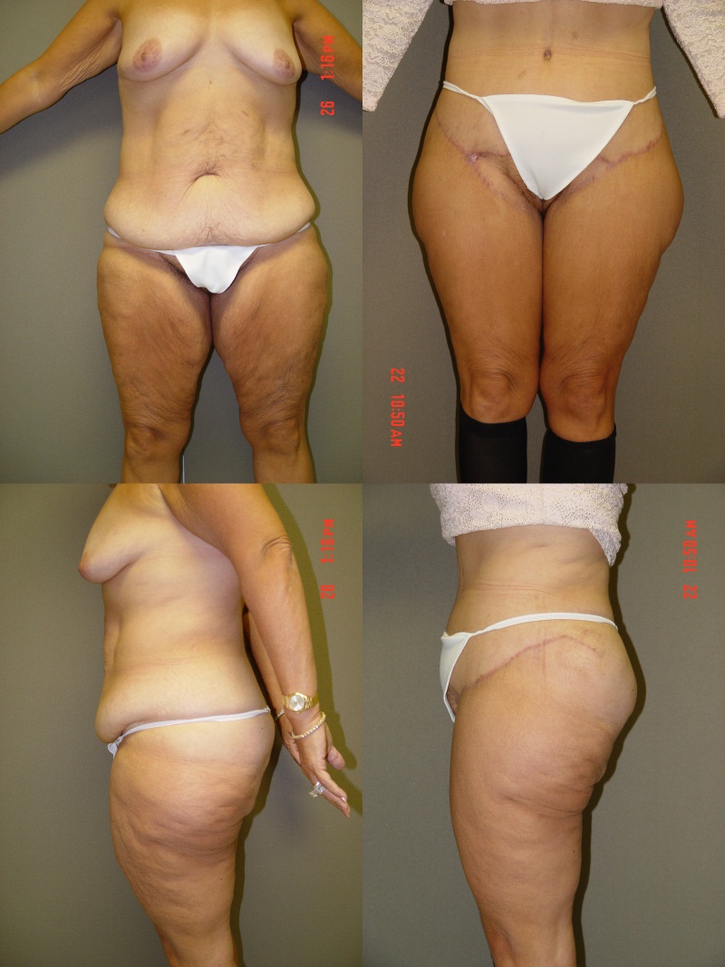 Thigh Lift / Reduction Before and After Photo by Renaissance Plastic Surgery in Troy Michigan