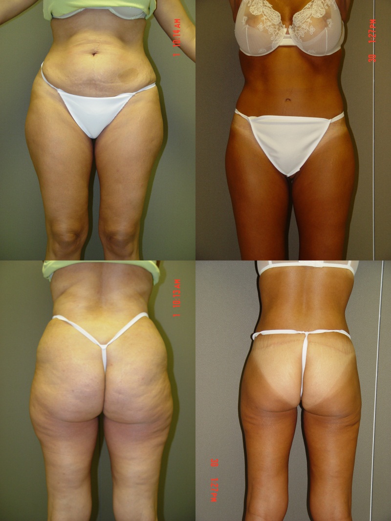 Thigh Lift / Reduction Before and After Photo by Renaissance Plastic Surgery in Troy Michigan