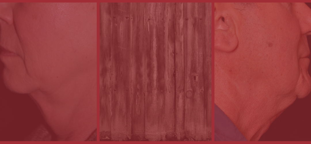 Facelift vs. Kybella