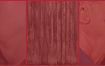 Facelift vs. Kybella