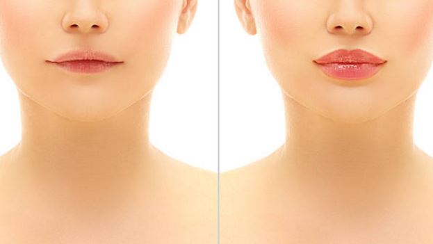 Lip Injections Can Create A More Youthful And Natural Lip Line