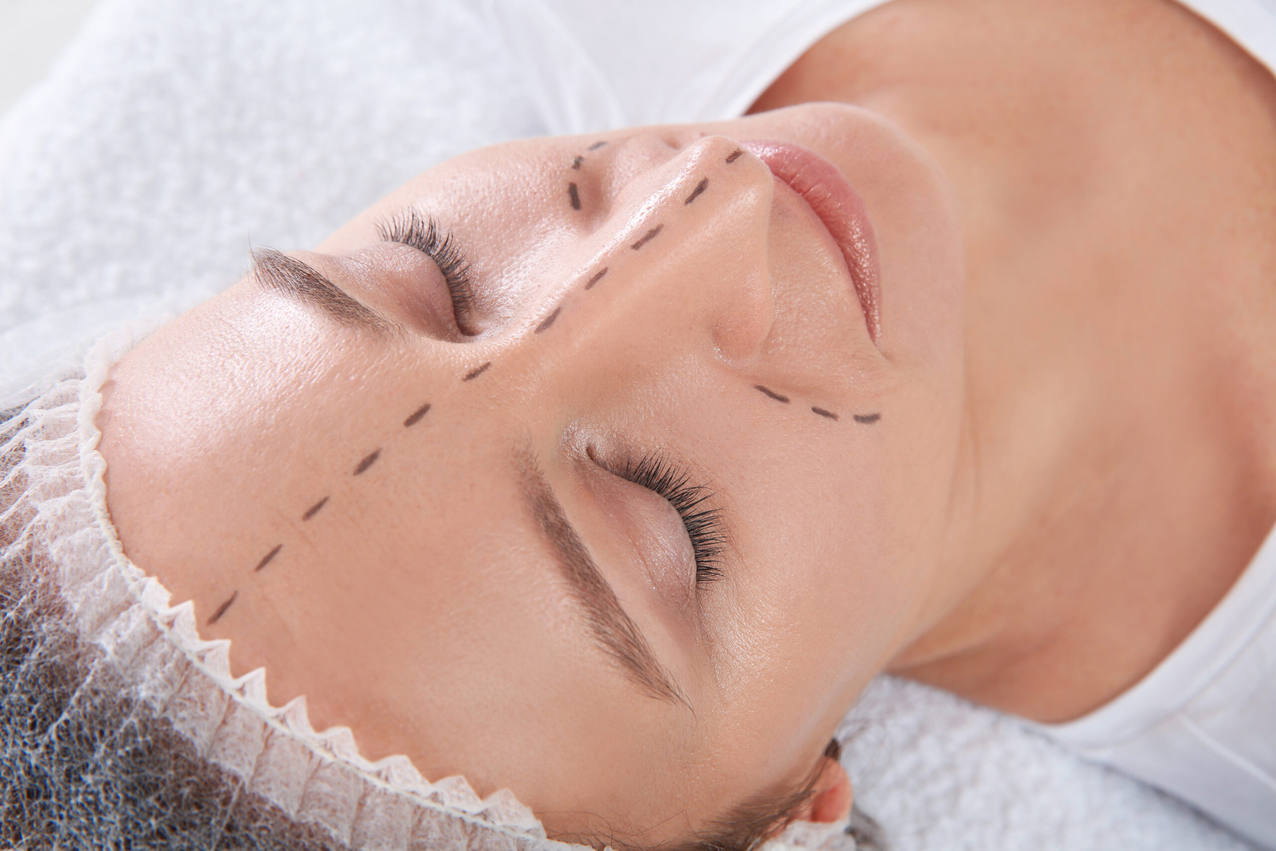 woman's face being marked up before rhinoplasty procedure
