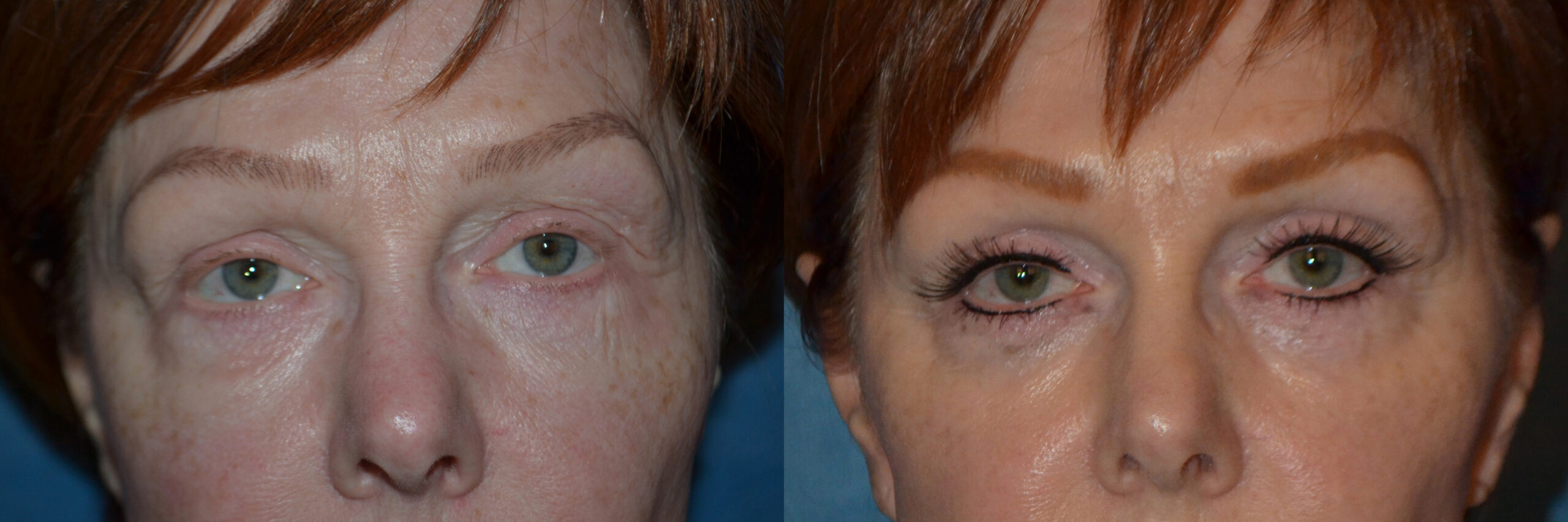 Blepharoplasty (Eyelid Surgery) before and after photo by Dr. Jeffrey L. Williams in Troy, MI
