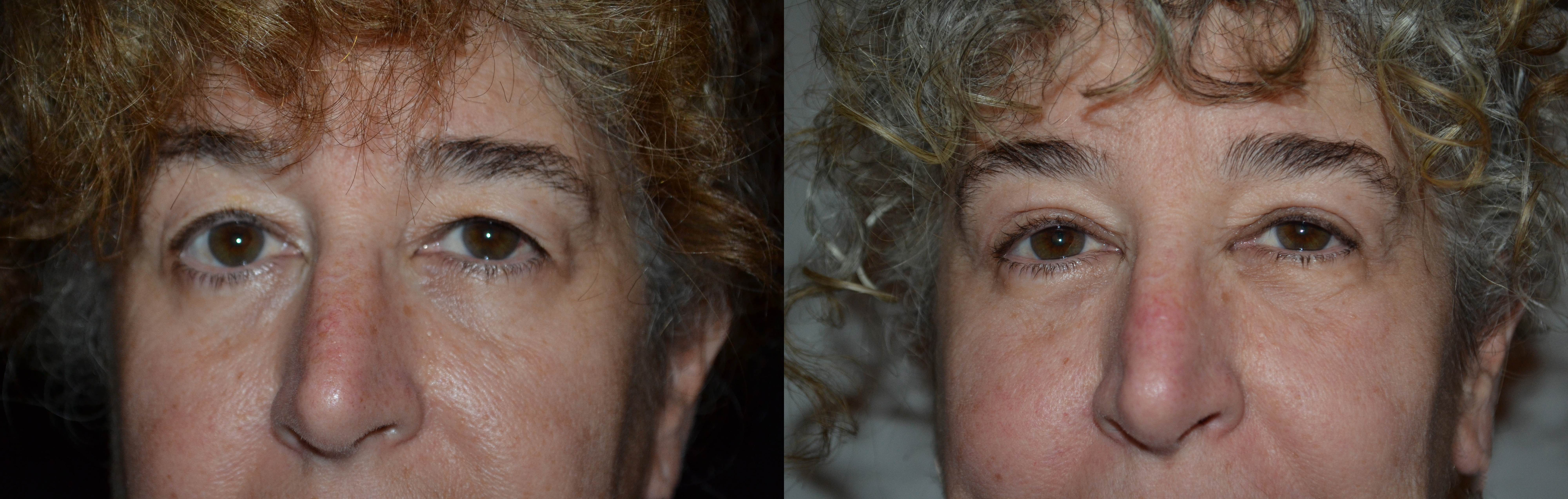 Blepharoplasty (Eyelid Surgery) before and after photo by Dr. Jeffrey L. Williams in Troy, MI