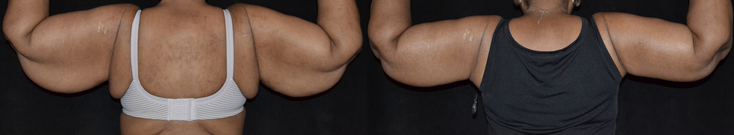 Brachioplasty (Upper Arm Reduction) before and after photo by Dr. William A. Stefani in Troy, MI