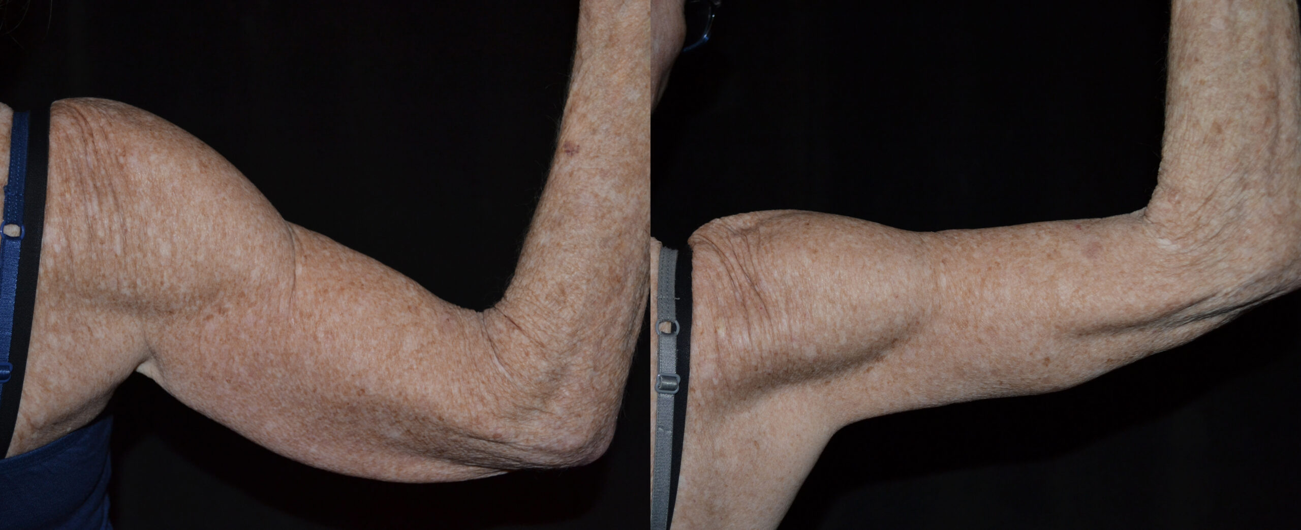 Brachioplasty (Upper Arm Reduction) before and after photo by Dr. William A. Stefani in Troy, MI