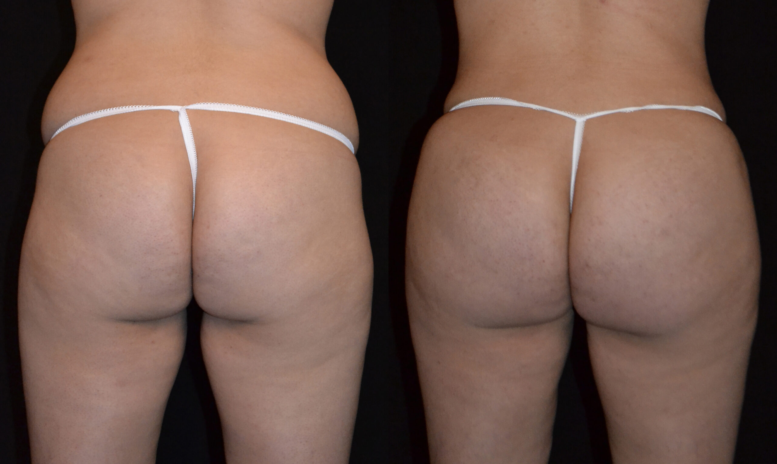 Liposuction before and after photo by Dr. William A. Stefani in Troy, MI