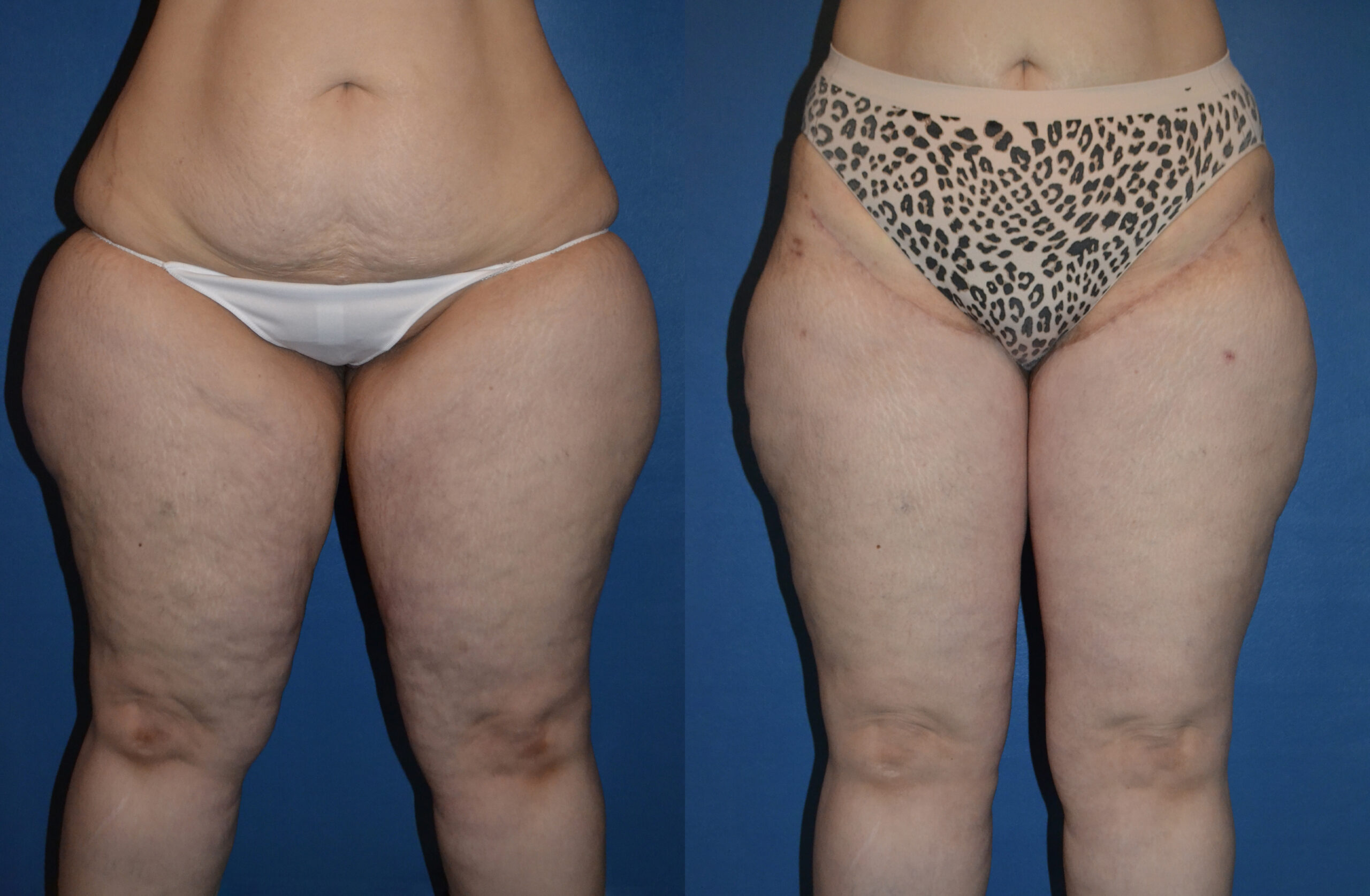 Liposuction before and after photo by Dr. William A. Stefani in Troy, MI