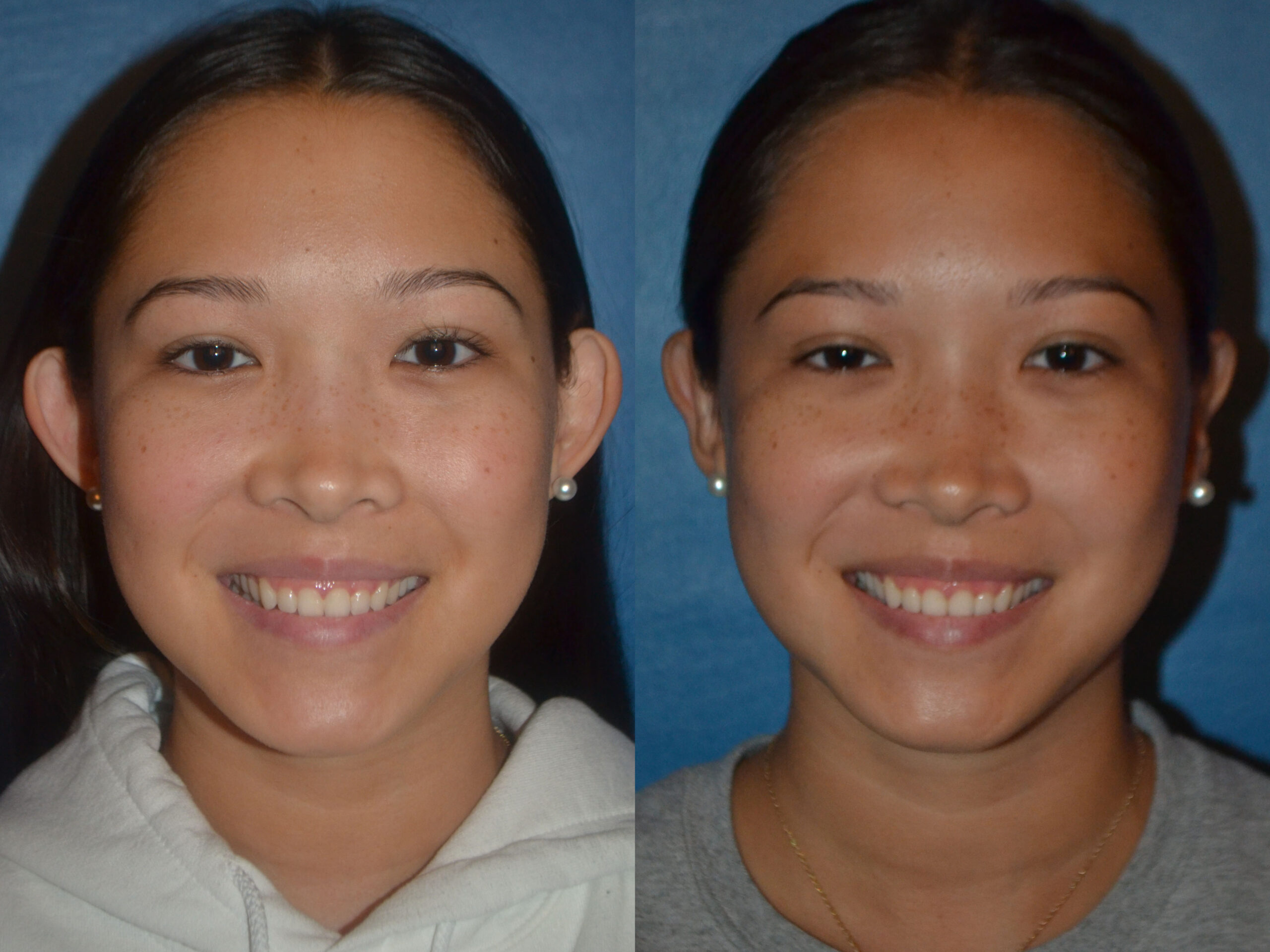 Otoplasty (Ear Surgery) before and after photo by Dr. George S. Miguel in Troy, MI
