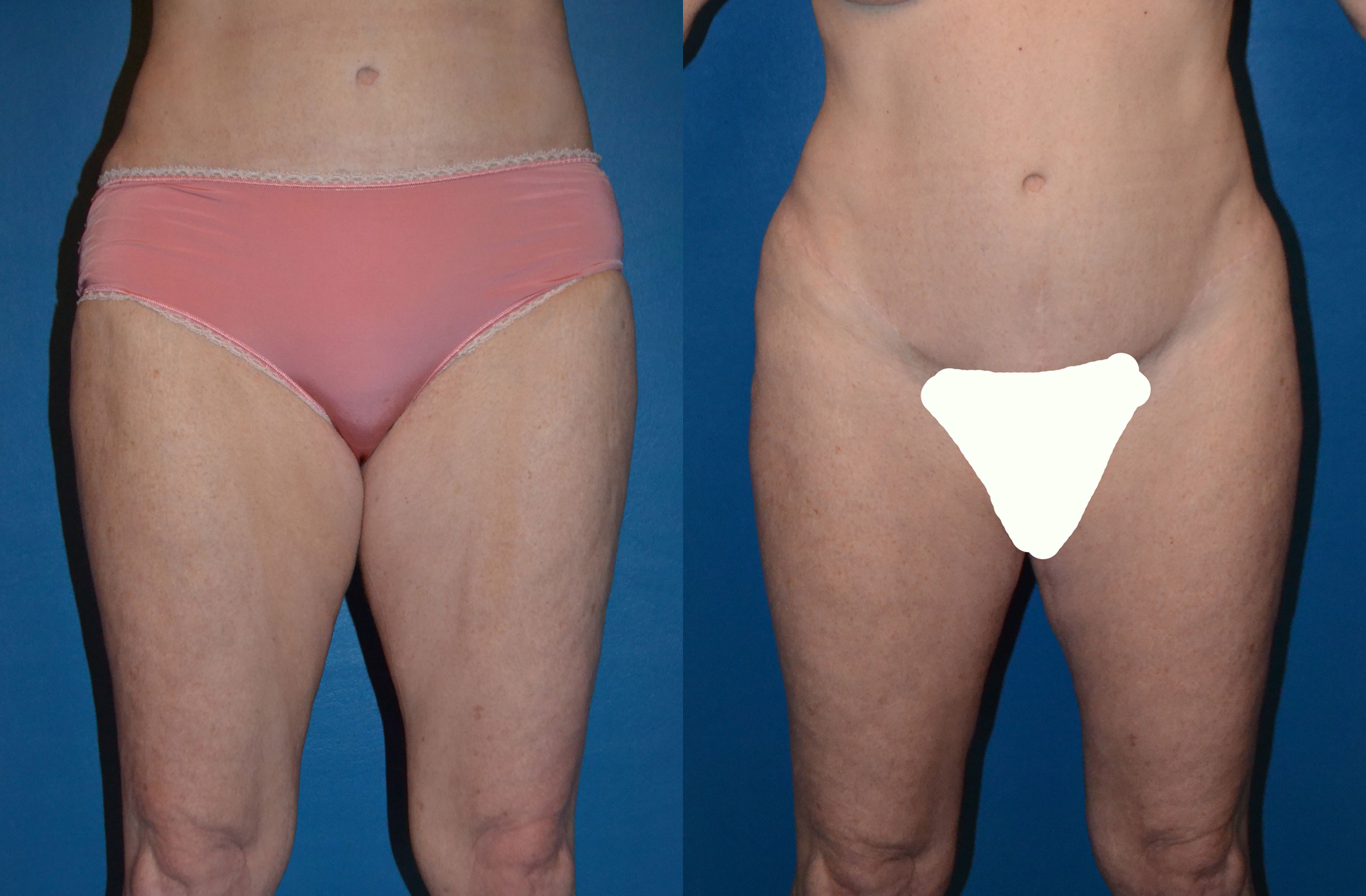 Thigh Lift before and after photo by Dr. Jeffrey L. Williams in Troy, MI