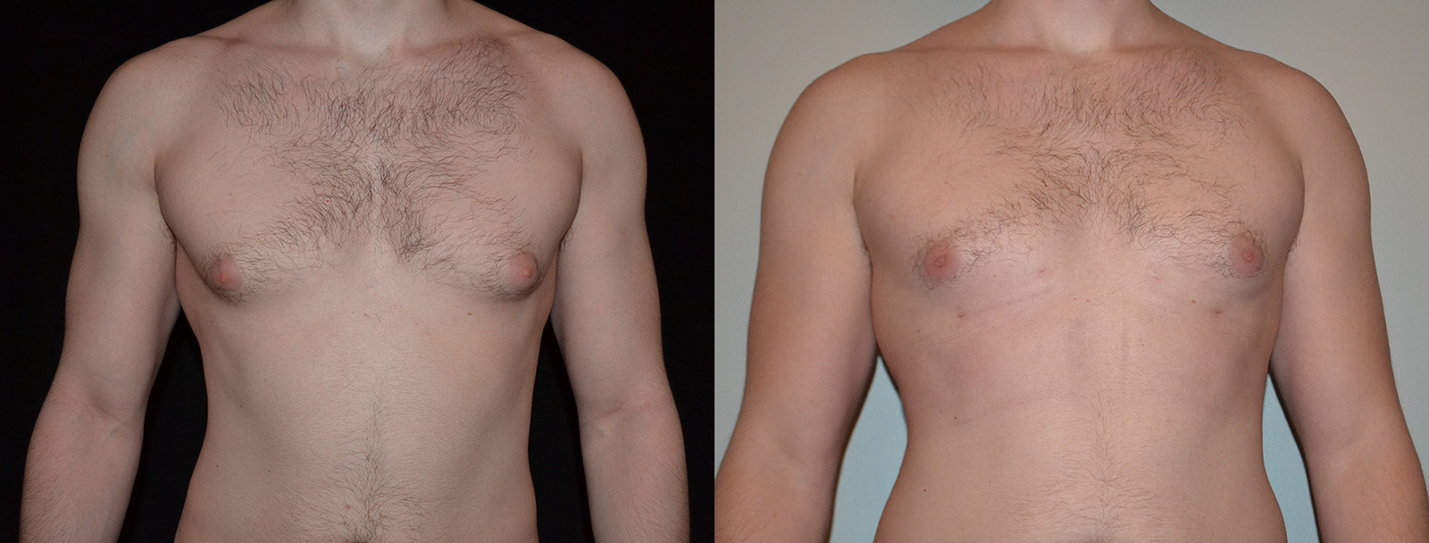 Gynecomastia before and after photo by Dr. Williams in Troy, MI