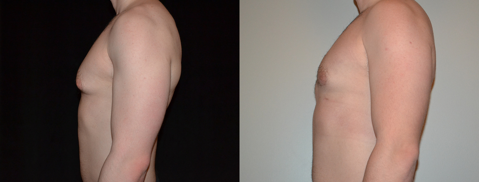 Gynecomastia before and after photo by Dr. Williams in Troy, MI
