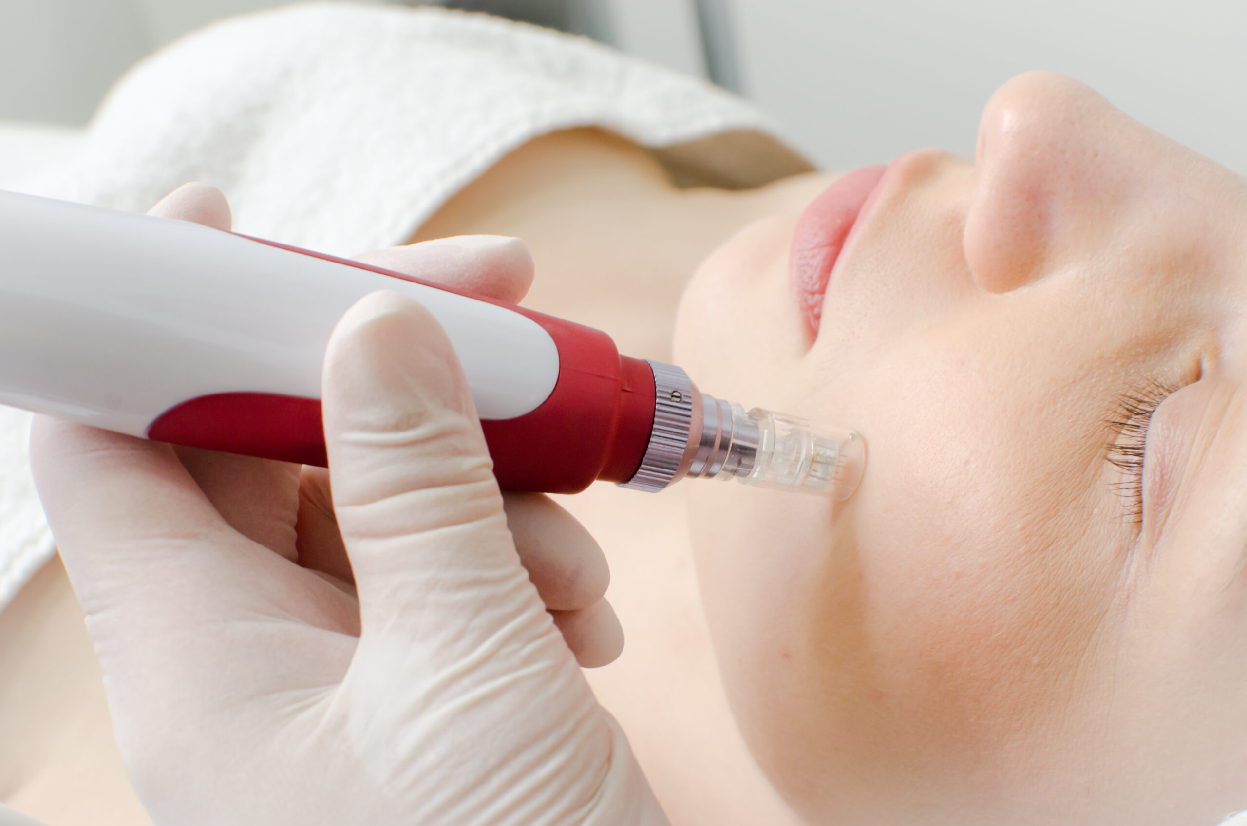 Dermatologist-Approved Microneedling for Skin Repair Aesthetician performing microneedling on patient